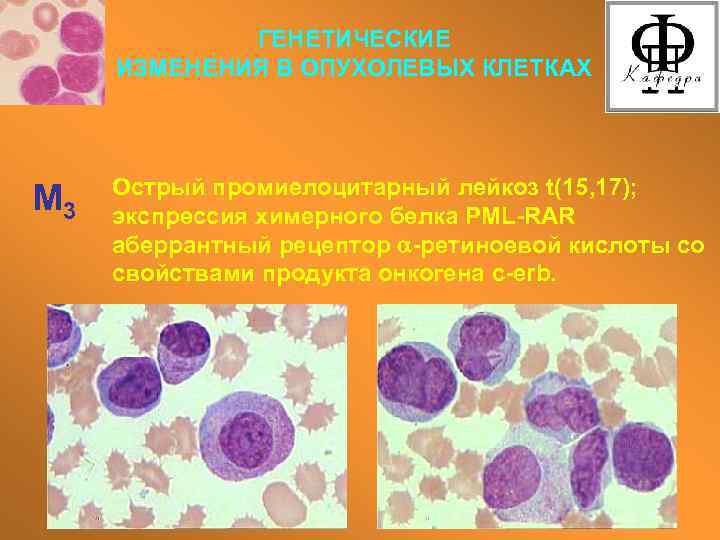 ГЕНЕТИЧЕСКИЕ ИЗМЕНЕНИЯ В ОПУХОЛЕВЫХ КЛЕТКАХ М 3 Острый промиелоцитарный лейкоз t(15, 17); экспрессия химерного