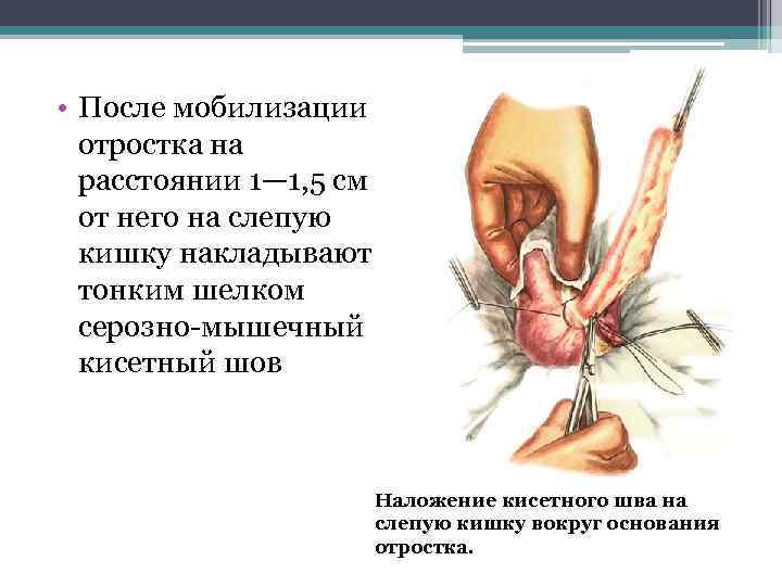  • После мобилизации отростка на расстоянии 1— 1, 5 см от него на