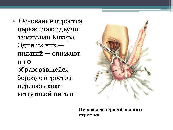  • Основание отростка пережимают двумя зажимами Кохера. Один из них — нижний —