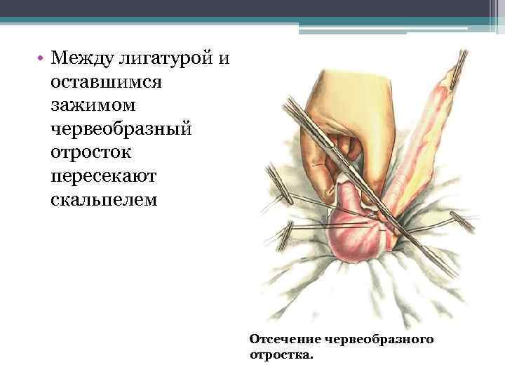  • Между лигатурой и оставшимся зажимом червеобразный отросток пересекают скальпелем Отсечение червеобразного отростка.