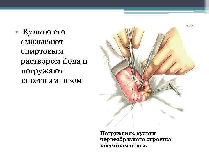  • Культю его смазывают спиртовым раствором йода и погружают кисетным швом Погружение культи
