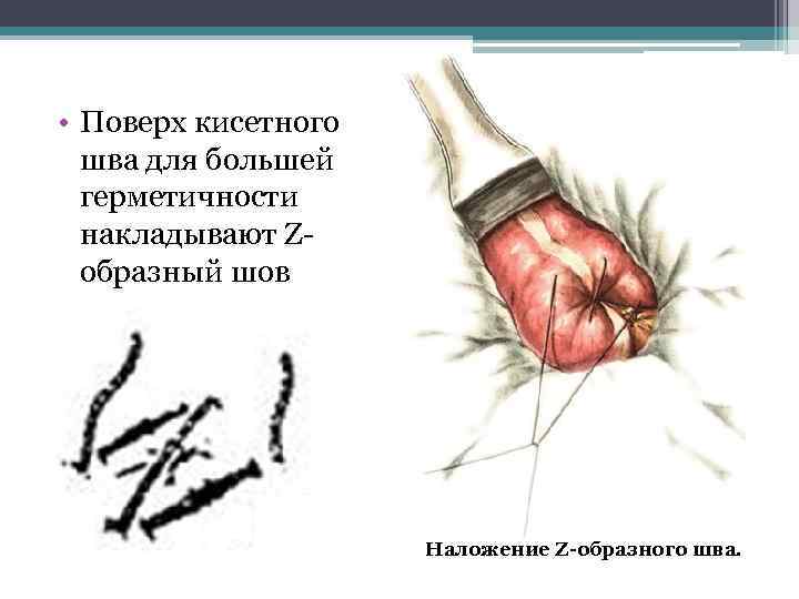  • Поверх кисетного шва для большей герметичности накладывают Zобразный шов Наложение Z-образного шва.
