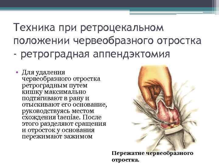 Техника при ретроцекальном положении червеобразного отростка - ретроградная аппендэктомия • Для удаления червеобразного отростка