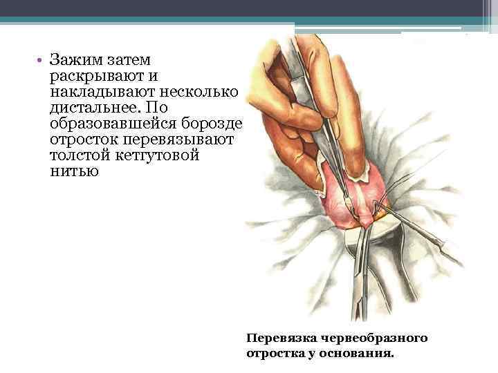  • Зажим затем раскрывают и накладывают несколько дистальнее. По образовавшейся борозде отросток перевязывают
