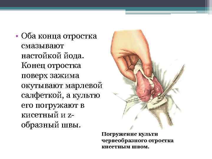  • Оба конца отростка смазывают настойкой йода. Конец отростка поверх зажима окутывают марлевой