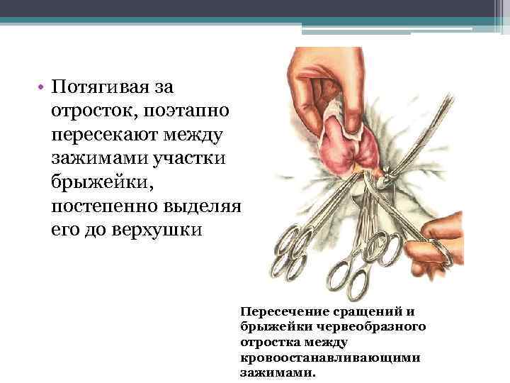  • Потягивая за отросток, поэтапно пересекают между зажимами участки брыжейки, постепенно выделяя его