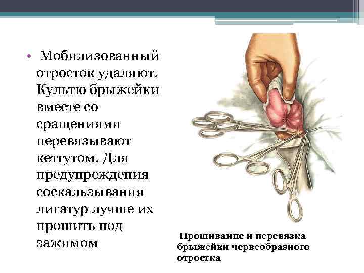  • Мобилизованный отросток удаляют. Культю брыжейки вместе со сращениями перевязывают кетгутом. Для предупреждения