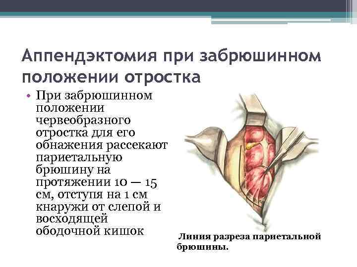 Особенности клинической картины острого аппендицита при тазовом расположении червеобразного отростка