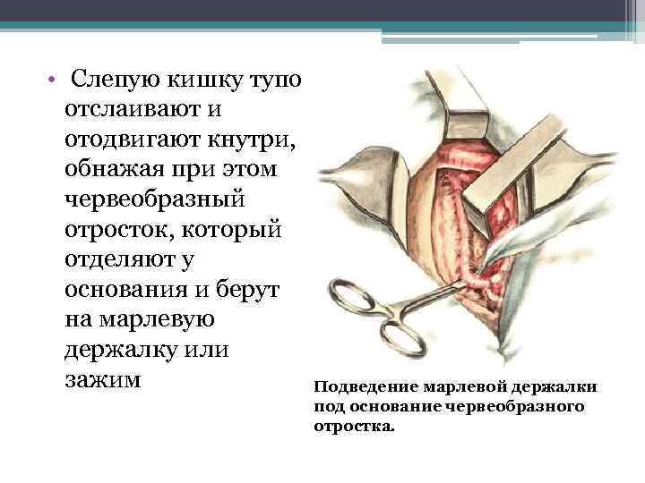  • Слепую кишку тупо отслаивают и отодвигают кнутри, обнажая при этом червеобразный отросток,
