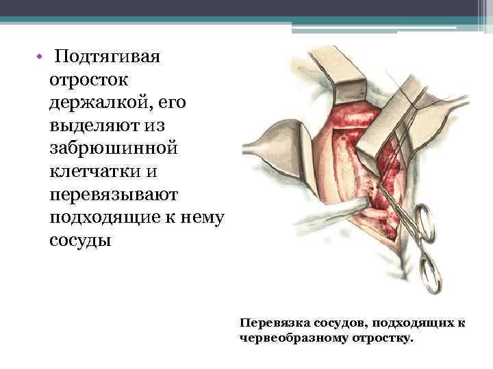  • Подтягивая отросток держалкой, его выделяют из забрюшинной клетчатки и перевязывают подходящие к