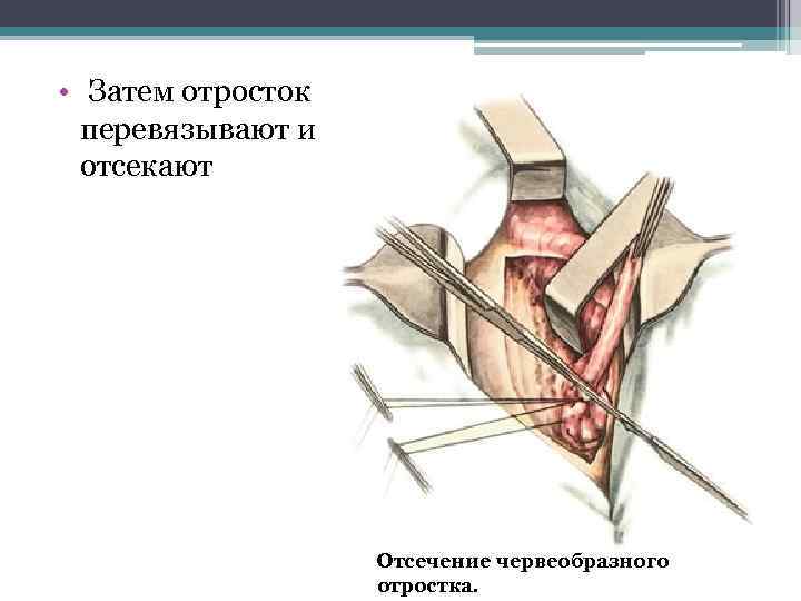  • Затем отросток перевязывают и отсекают Отсечение червеобразного отростка. 