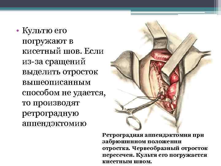  • Культю его погружают в кисетный шов. Если из-за сращений выделить отросток вышеописанным
