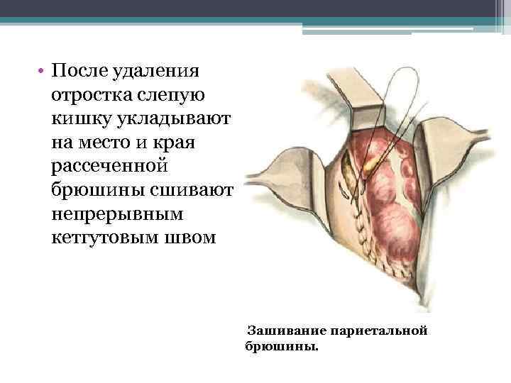  • После удаления отростка слепую кишку укладывают на место и края рассеченной брюшины