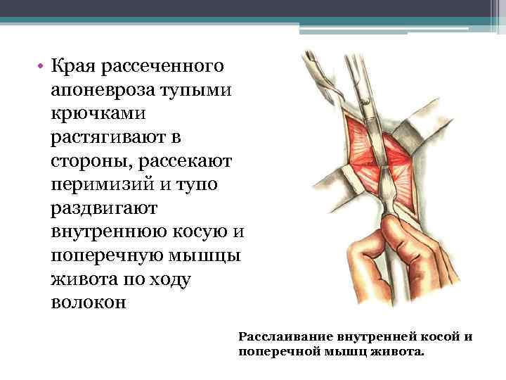  • Края рассеченного апоневроза тупыми крючками растягивают в стороны, рассекают перимизий и тупо