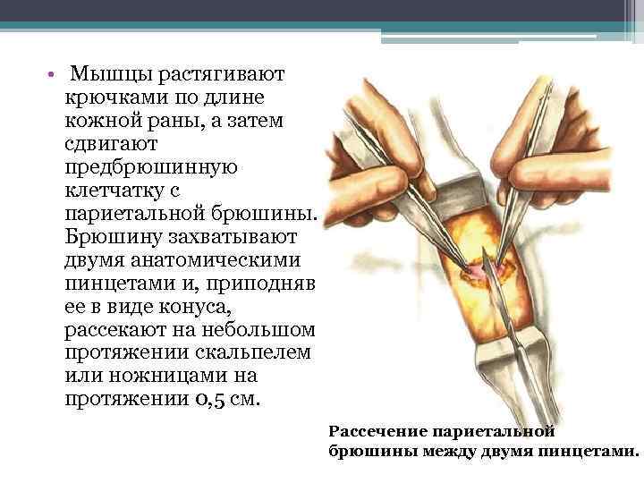  • Мышцы растягивают крючками по длине кожной раны, а затем сдвигают предбрюшинную клетчатку