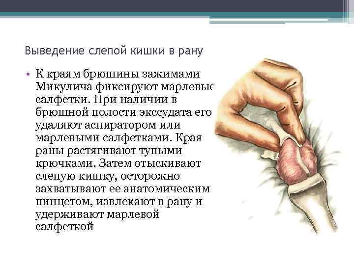 Выведение слепой кишки в рану • К краям брюшины зажимами Микулича фиксируют марлевые салфетки.