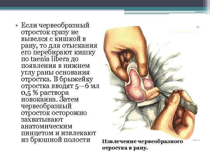  • Если червеобразный отросток сразу не вывелся с кишкой в рану, то для