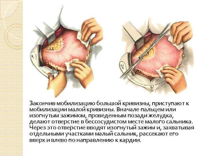 Закончив мобилизацию большой кривизны, приступают к мобилизации малой кривизны. Вначале пальцем или изогнутым зажимом,