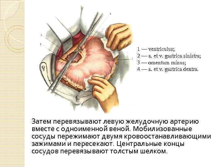 1 — ventriсulus; 2 — a. et v. gastrica sinistra; 3 — omentum minus;