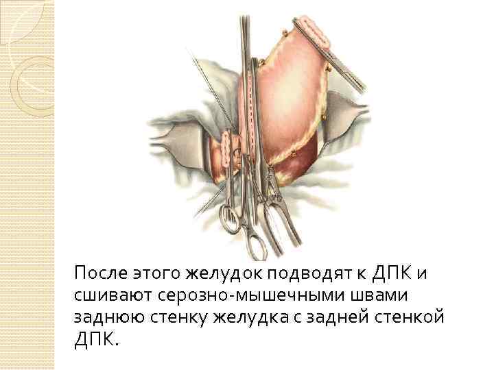 После этого желудок подводят к ДПК и сшивают серозно-мышечными швами заднюю стенку желудка с