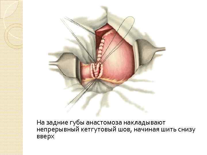 На задние губы анастомоза накладывают непрерывный кетгутовый шов, начиная шить снизу вверх 
