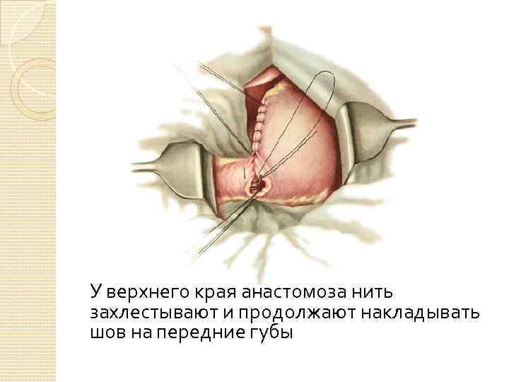 У верхнего края анастомоза нить захлестывают и продолжают накладывать шов на передние губы 