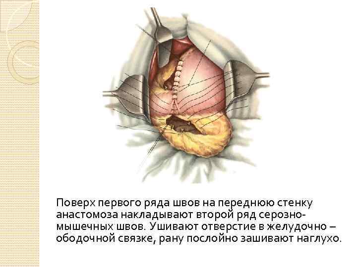 Поверх первого ряда швов на переднюю стенку анастомоза накладывают второй ряд серозномышечных швов. Ушивают