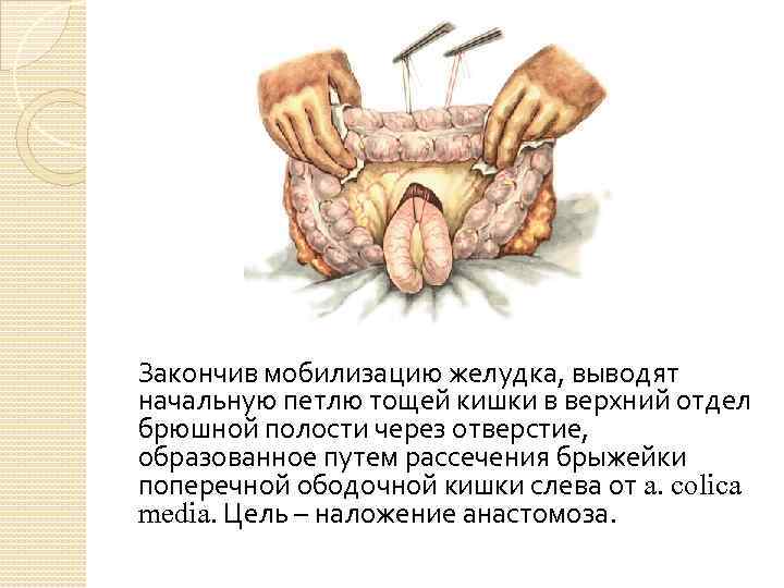 Закончив мобилизацию желудка, выводят начальную петлю тощей кишки в верхний отдел брюшной полости через