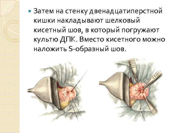  Затем на стенку двенадцатиперстной кишки накладывают шелковый кисетный шов, в который погружают культю