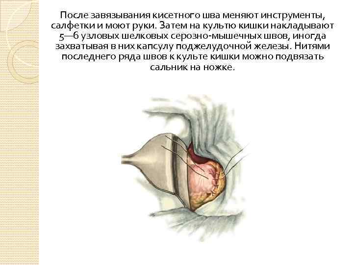 После завязывания кисетного шва меняют инструменты, салфетки и моют руки. Затем на культю кишки