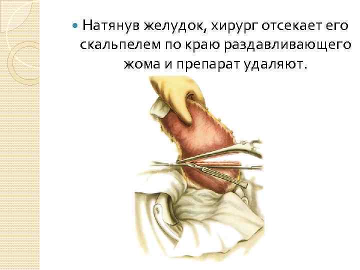  Натянув желудок, хирург отсекает его скальпелем по краю раздавливающего жома и препарат удаляют.