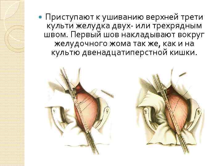  Приступают к ушиванию верхней трети культи желудка двух- или трехрядным швом. Первый шов