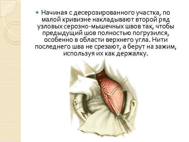 Начиная с десерозированного участка, по малой кривизне накладывают второй ряд узловых серозно-мышечных швов так,