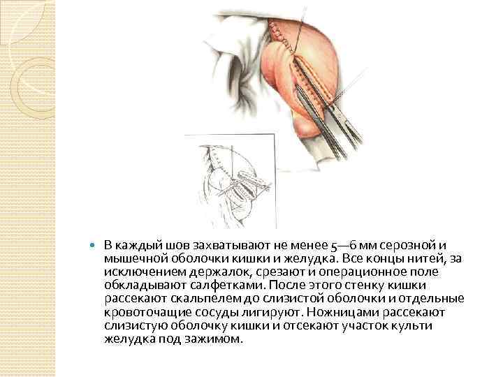  В каждый шов захватывают не менее 5— 6 мм серозной и мышечной оболочки