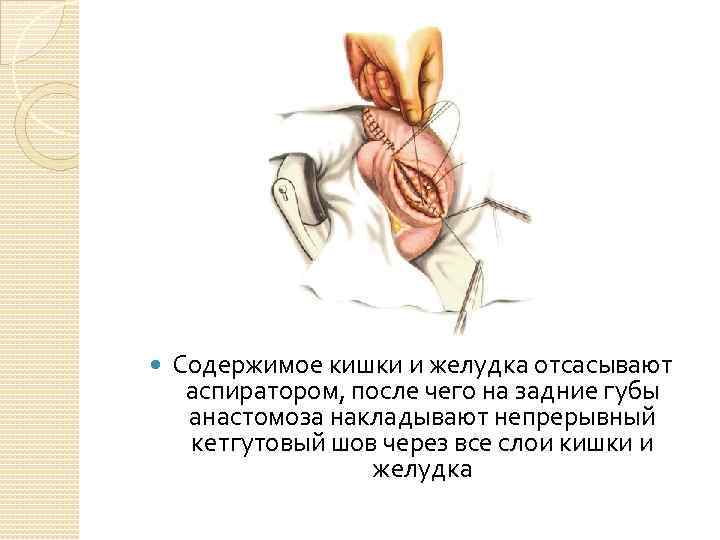  Содержимое кишки и желудка отсасывают аспиратором, после чего на задние губы анастомоза накладывают