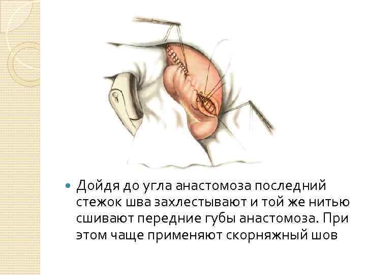  Дойдя до угла анастомоза последний стежок шва захлестывают и той же нитью сшивают