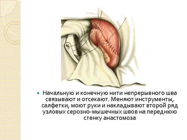  Начальную и конечную нити непрерывного шва связывают и отсекают. Меняют инструменты, салфетки, моют