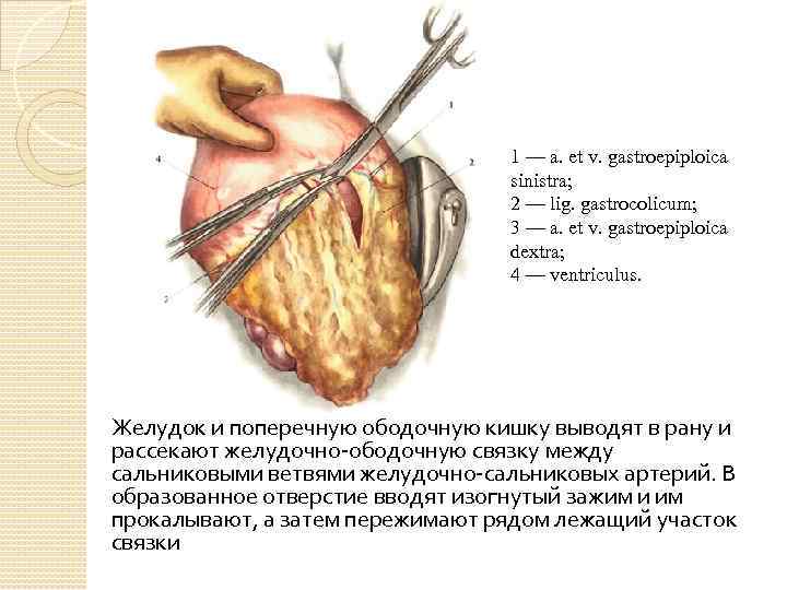 1 — a. et v. gastroepiploica sinistra; 2 — lig. gastrocolicum; 3 — a.