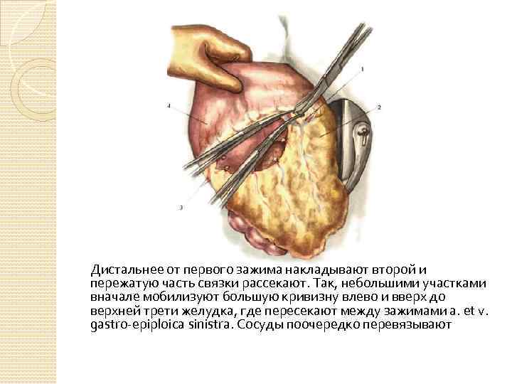 Дистальнее от первого зажима накладывают второй и пережатую часть связки рассекают. Так, небольшими участками