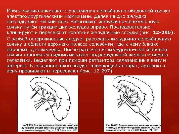 Мобилизацию начинают с рассечения селезёночно-ободочной связки электрохирургическими ножницами. Далее на дно желудка накладывают мягкий