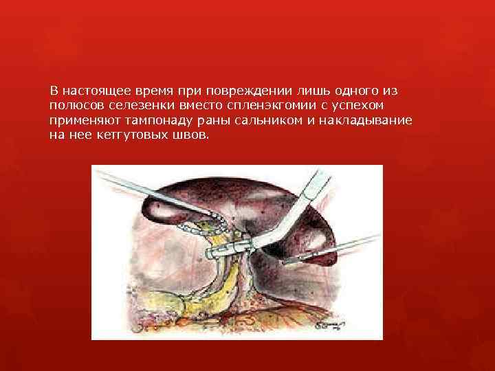 В настоящее время при повреждении лишь одного из полюсов селезенки вместо спленэкгомии с успехом