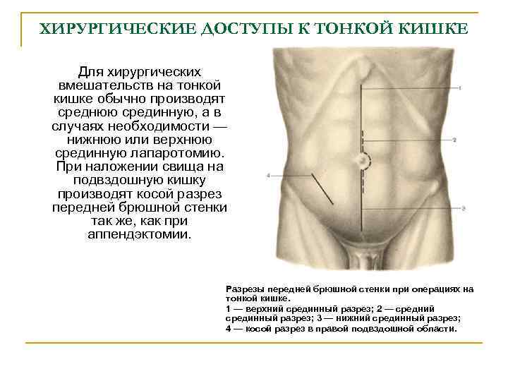 ХИРУРГИЧЕСКИЕ ДОСТУПЫ К ТОНКОЙ КИШКЕ Для хирургических вмешательств на тонкой кишке обычно производят среднюю