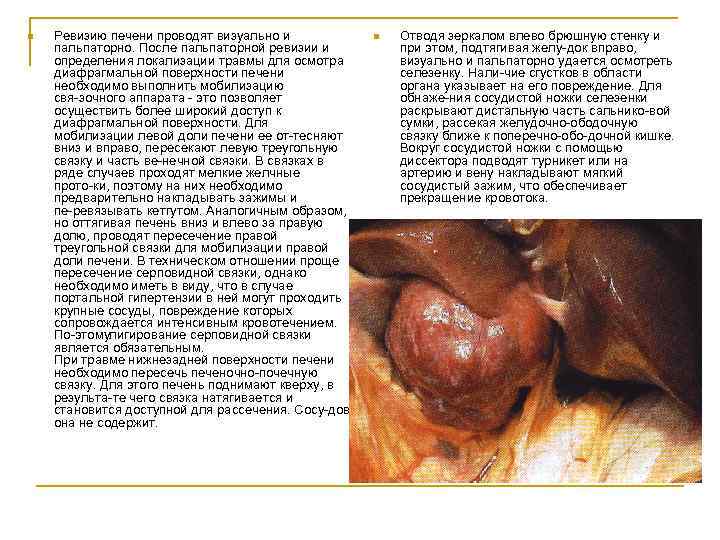 n Ревизию печени проводят визуально и пальпаторно. После пальпаторной ревизии и определения локализации травмы