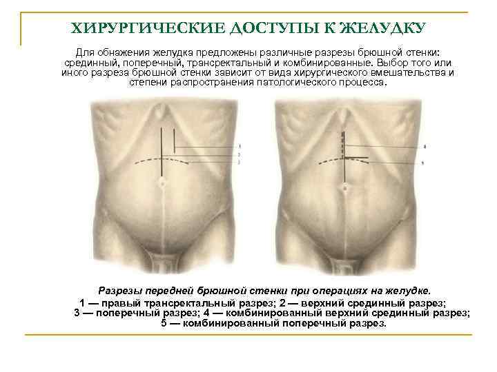 ХИРУРГИЧЕСКИЕ ДОСТУПЫ К ЖЕЛУДКУ Для обнажения желудка предложены различные разрезы брюшной стенки: срединный, поперечный,