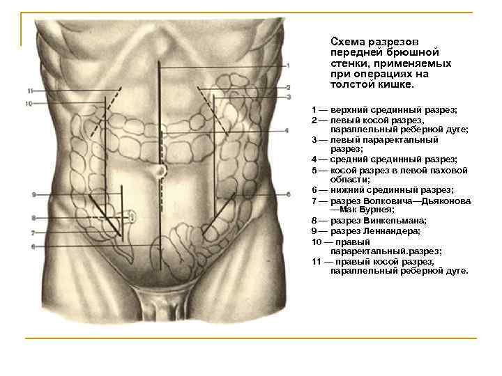 Толстая брюшная стенка. Параректальный разрез передней брюшной стенки. Анатомия брюшной полости человека схема расположения у мужчин. Область пупка анатомия передней брюшной стенки. Срединный разрез брюшной полости.