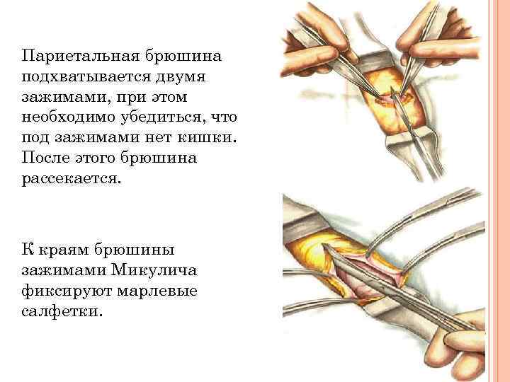 Париетальная брюшина подхватывается двумя зажимами, при этом необходимо убедиться, что под зажимами нет кишки.
