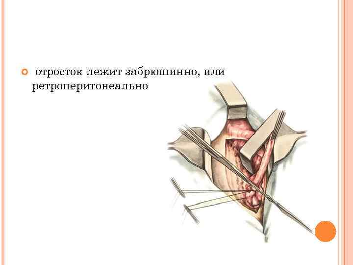  отросток лежит забрюшинно, или ретроперитонеально 