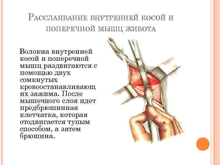 РАССЛАИВАНИЕ ВНУТРЕННЕЙ КОСОЙ И ПОПЕРЕЧНОЙ МЫШЦ ЖИВОТА Волокна внутренней косой и поперечной мышц раздвигаются