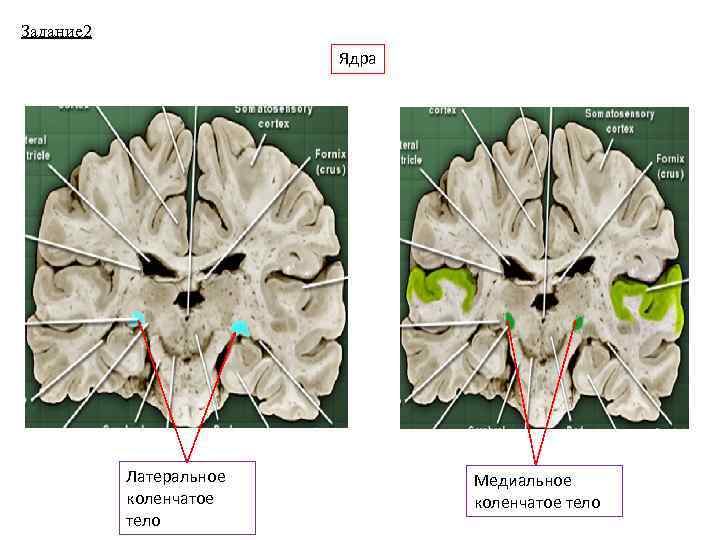Задание 2 Ядра Латеральное коленчатое тело Медиальное коленчатое тело 