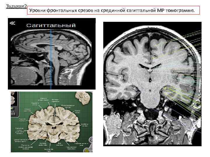 Задание 2 Уровни фронтальных срезов на срединной сагиттальной МР томограмме. 